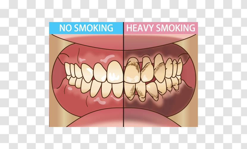 Tooth Dentist Periodontal Disease Tobacco Smoking 歯科 - Tongue Transparent PNG
