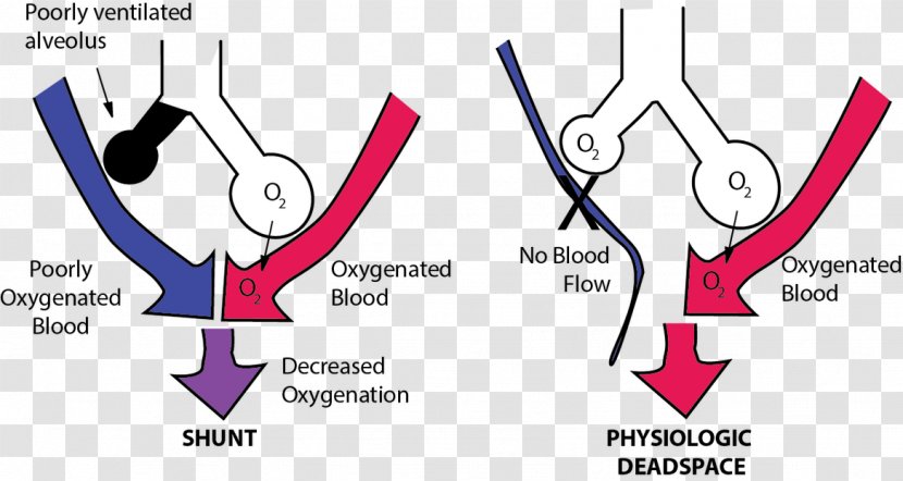 Pulmonary Shunt Ventilation/perfusion Ratio Dead Space - Heart Transparent PNG