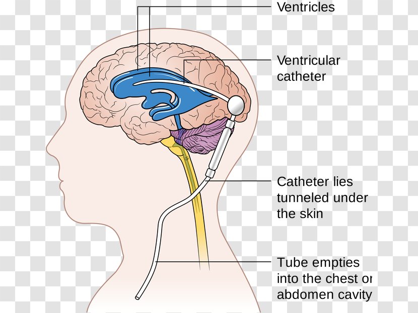 Cerebral Shunt Neurosurgery Hydrocephalus Cerebrospinal Fluid - Frame - Brain Transparent PNG