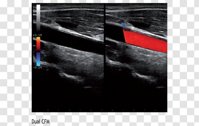 Ultrasonography Common Carotid Artery Ultrasound Cardiovascular Disease Cardiology - Doppler Echocardiography - Advanced Technology Transparent PNG