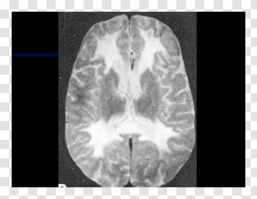 Computed Tomography Lääketieteellinen Röntgenkuvaus X-ray Brain Radiography - Flower Transparent PNG