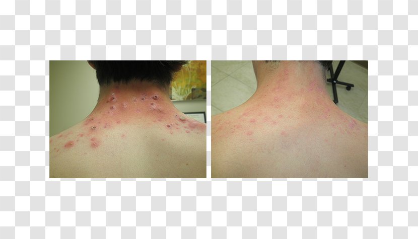 Isotretinoin Acne Scar Human Back Surgery - Frame - Month Of Fasting Transparent PNG