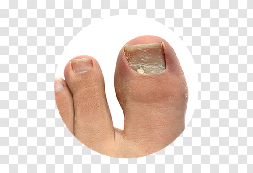Onychomycosis Athlete's Foot Toe Nail Onychocryptosis - Thumb Transparent PNG