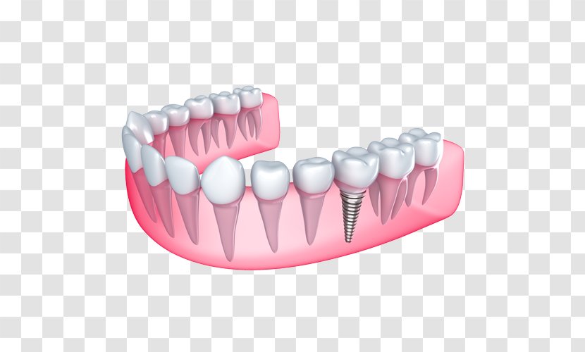 Dental Implant Cosmetic Dentistry Dentures - Tree - Health Transparent PNG