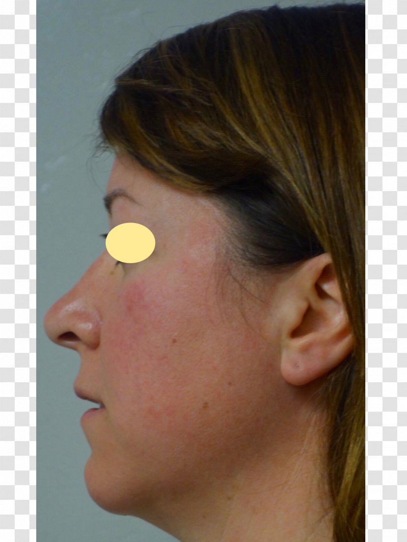 Nose Cheek Chin Forehead Eyebrow - Jaw - Buccal Fat Removal Transparent PNG