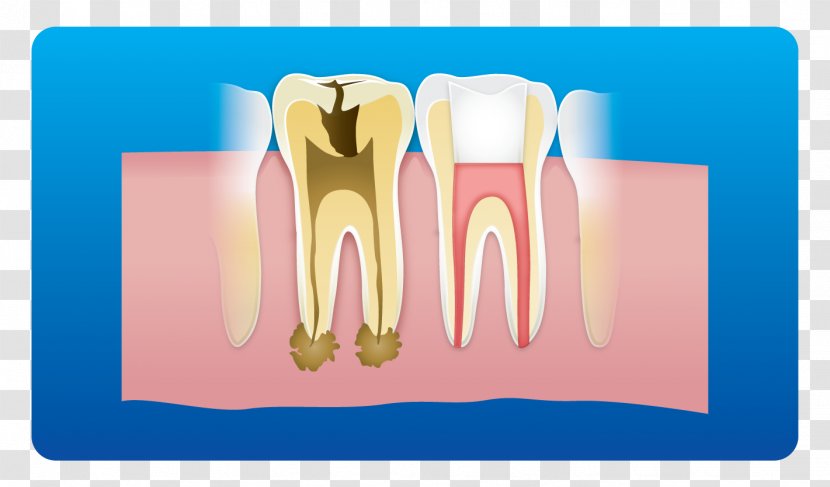 Tooth Dental Implant Root Canal Dentistry Pulp - Watercolor - Clinic Card Transparent PNG