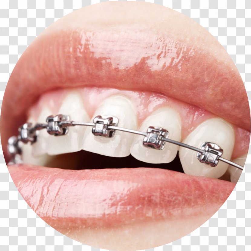 Orthodontics Dental Braces Dentistry Damon System - Implant - Care Transparent PNG