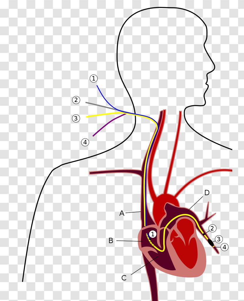 Pulmonary Artery Catheter Hypertension Wedge Pressure - Tree - Heart Transparent PNG