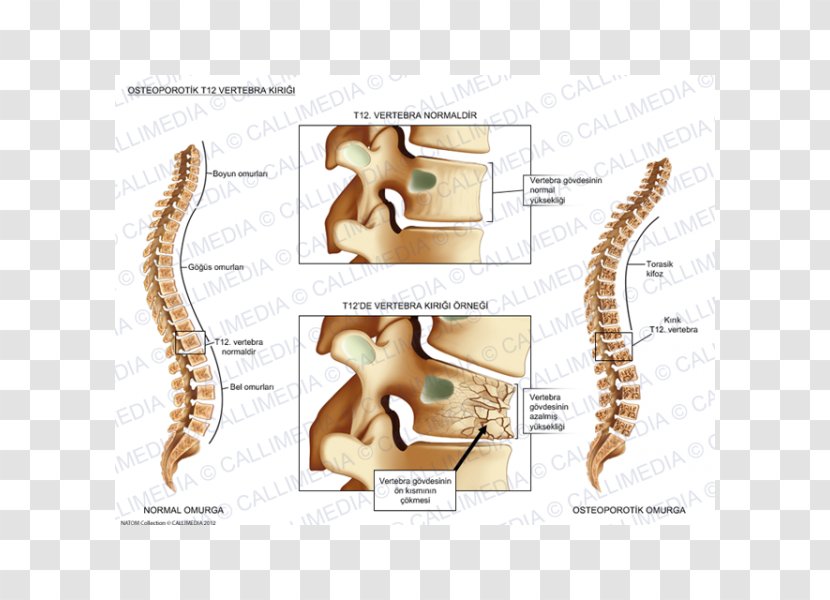Vertebral Column Bone Fracture Compression Anatomy - Cartoon - Fractures Transparent PNG