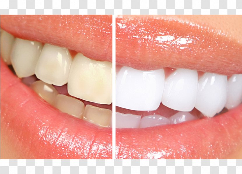 Cosmetic Dentistry Tooth Whitening - Hollywood Smile Transparent PNG