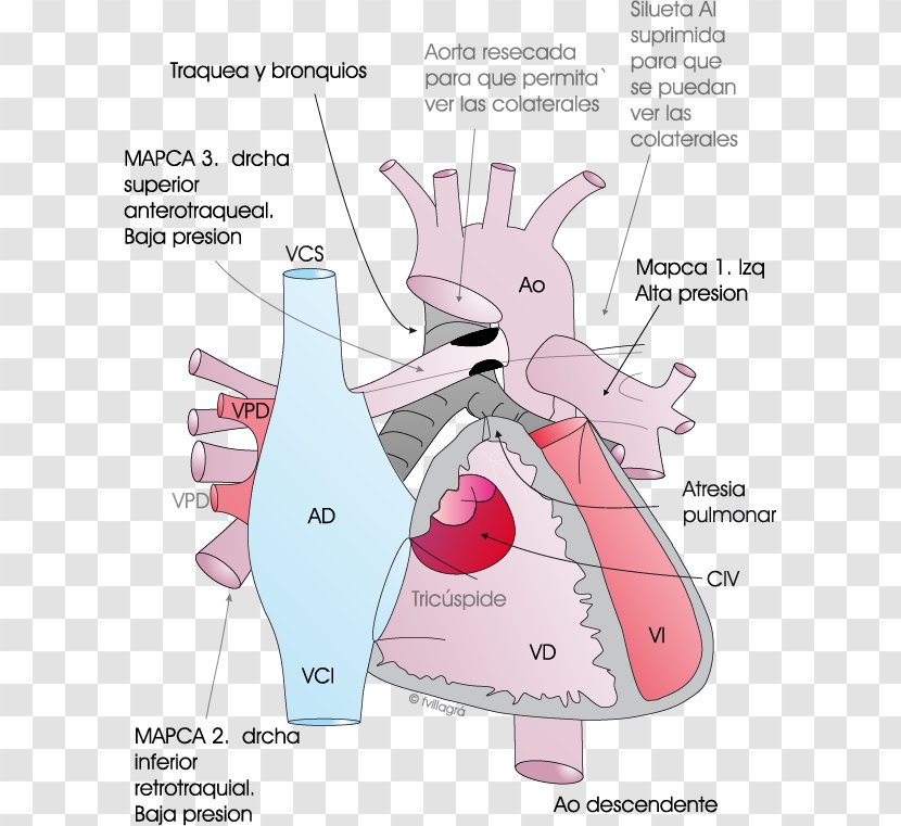 Pulmonary Atresia Ventricular Septal Defect Artery Aorta - Tree - Cartoon Transparent PNG
