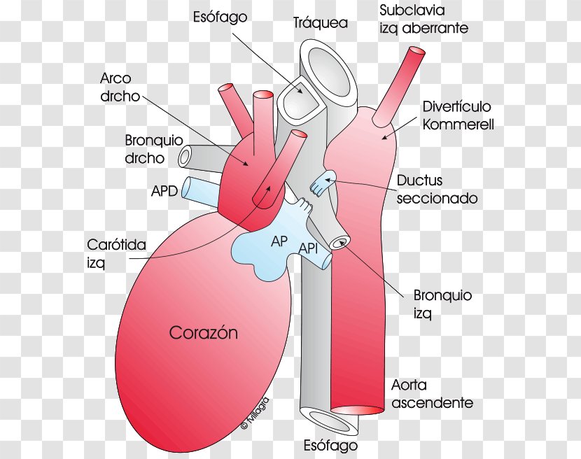 Aberrant Subclavian Artery Aortic Arch Aorta Diverticolo Di Kommerell - Tree - Heart Transparent PNG