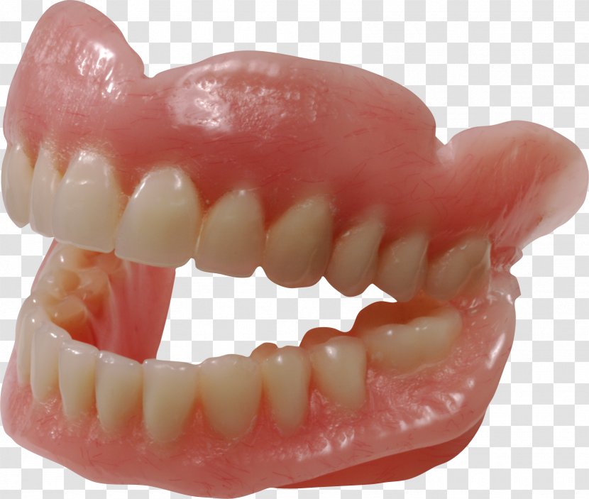 Dentures Dentistry Human Tooth Removable Partial Denture - Teeth Image Transparent PNG