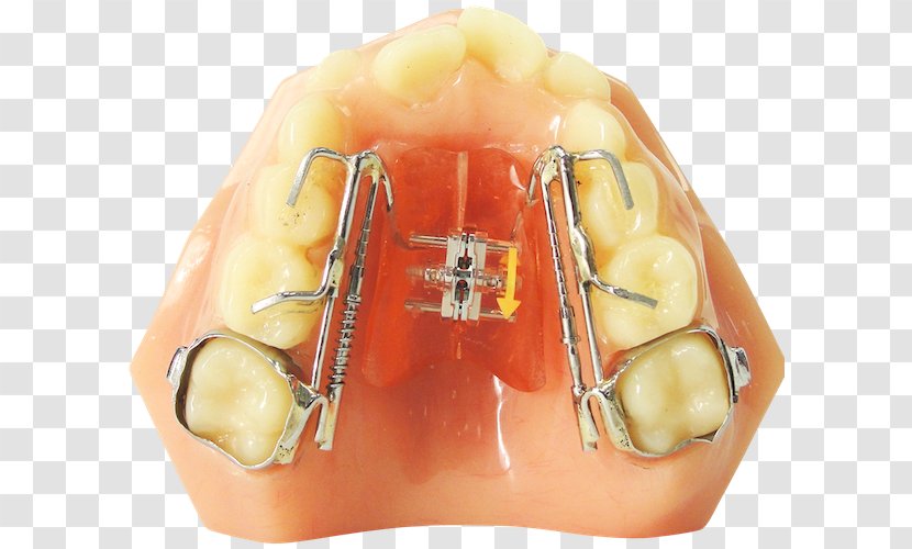 Tooth Orthodontic Technology Orthodontics Dentistry Clear Aligners - Roa Ricoh Appliances - Nail Transparent PNG