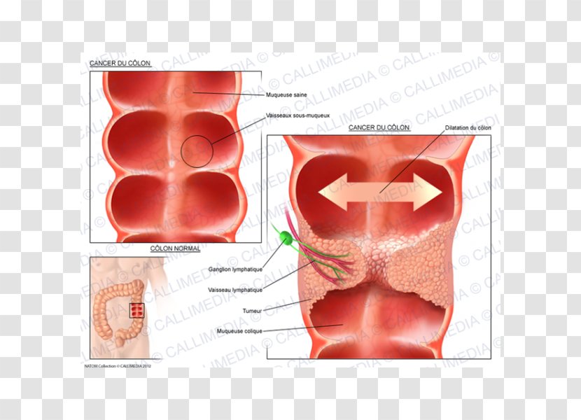 Illustration Anatomique Ductal Carcinoma In Situ Oncology - Frame - Colon Cancer Transparent PNG