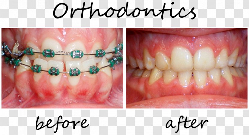 Tooth Orthodontics Dentistry Veneer Dental Implant - Crown Transparent PNG