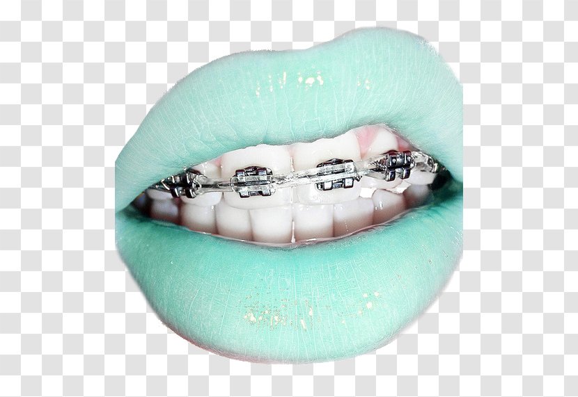 Dental Braces Clear Aligners Lip Retainer Tooth - Brace Transparent PNG