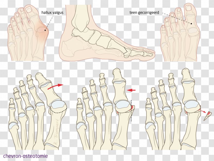 Thumb Hallux Foot Bunion Toe - Watercolor - Silhouette Transparent PNG