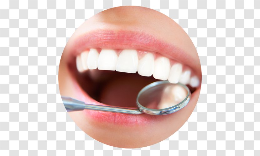 Dentistry Scaling And Root Planing Dental Implant Teeth Cleaning - Smile - Health Transparent PNG