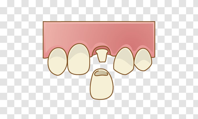 Sakayori Dental Clinic Dentistry 歯科 歯冠継続歯 - Eyewear - Dentures Transparent PNG