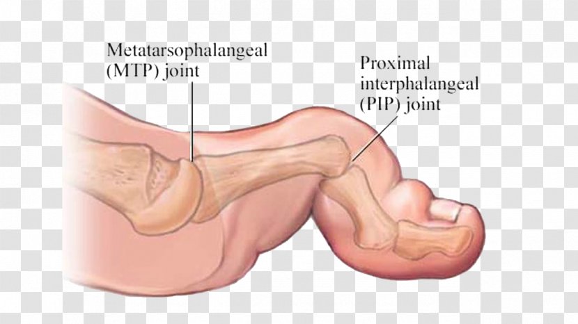 Bent Finger Foot Ankle Human Body Pain - Frame - Corns Transparent PNG