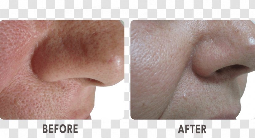 La Skinnovita- Dr. Anuj Pall Dermatology, Laser & Hair Centre Nose Cheek Chin Collagen Induction Therapy - Skin - Sekhmet Transparent PNG