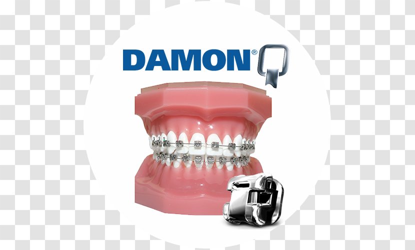 Damon System Dental Braces Orthodontics Self-ligating Bracket Dentistry - Selfligating Transparent PNG