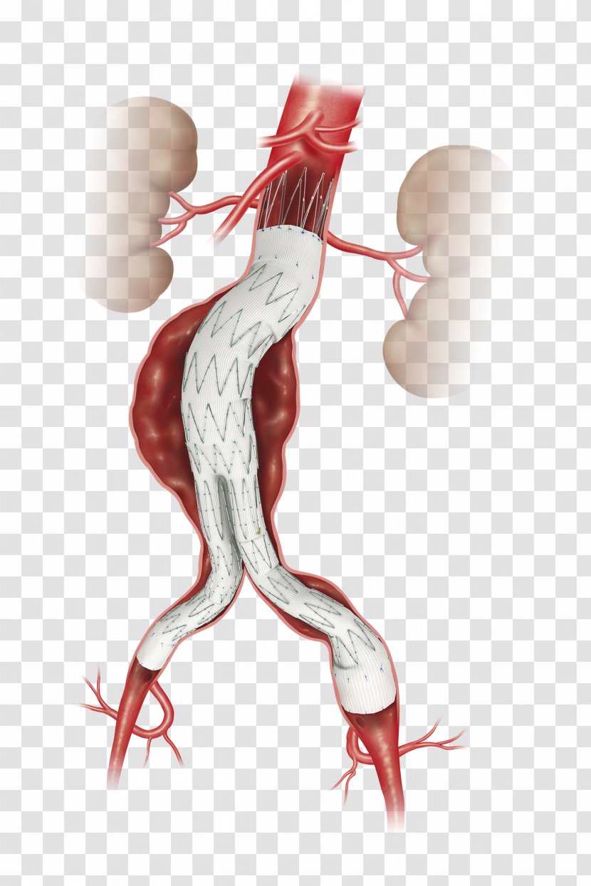 Abdominal Aortic Aneurysm Endovascular Repair Aorta - Tree - Cartoon Transparent PNG