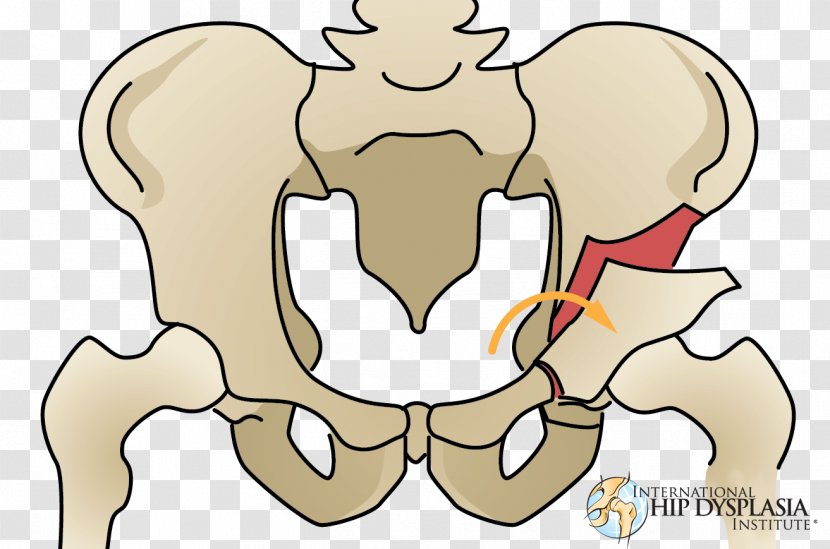 Osteotomy Hip Dysplasia Acetabulum Femur - Watercolor - Bones Transparent PNG