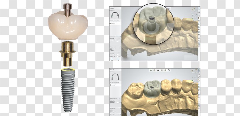 Dental Implant Temporary Crown Screw - Titanium Transparent PNG