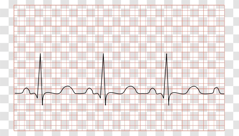 Electrocardiography Sinus Tachycardia Heart Rate - Silhouette - Svt Ecg Transparent PNG