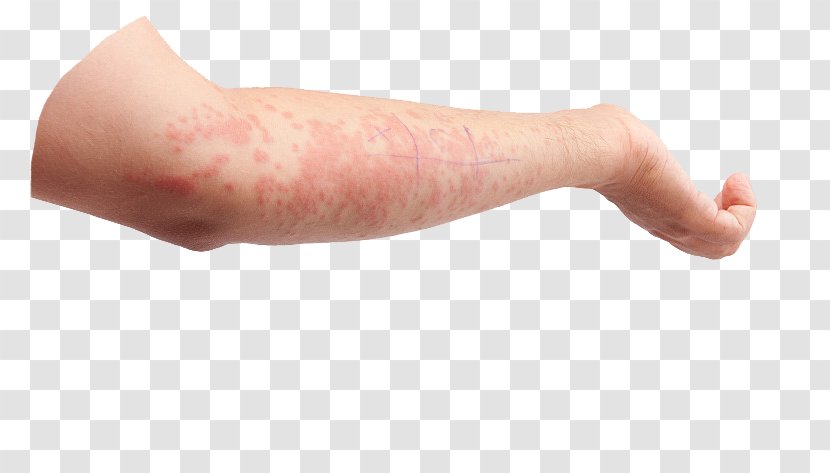 Skin Psoriasis Symptom Dermatology Thumb - Hand Allergy Transparent PNG