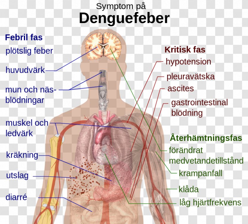 Dengue Virus Symptom Viral Hemorrhagic Fever - Watercolor - Health Transparent PNG