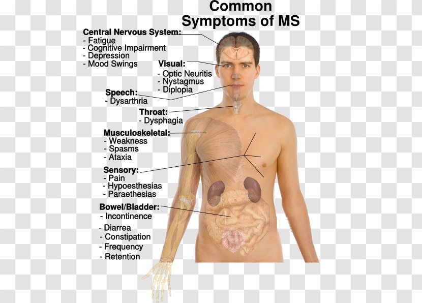 Multiple Sclerosis Signs And Symptoms Medical Sign Disease - Frame - M Ms Transparent PNG