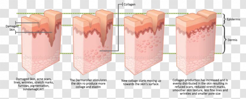 Collagen Induction Therapy Dermis Skin Care - Within Broken Up Transparent PNG