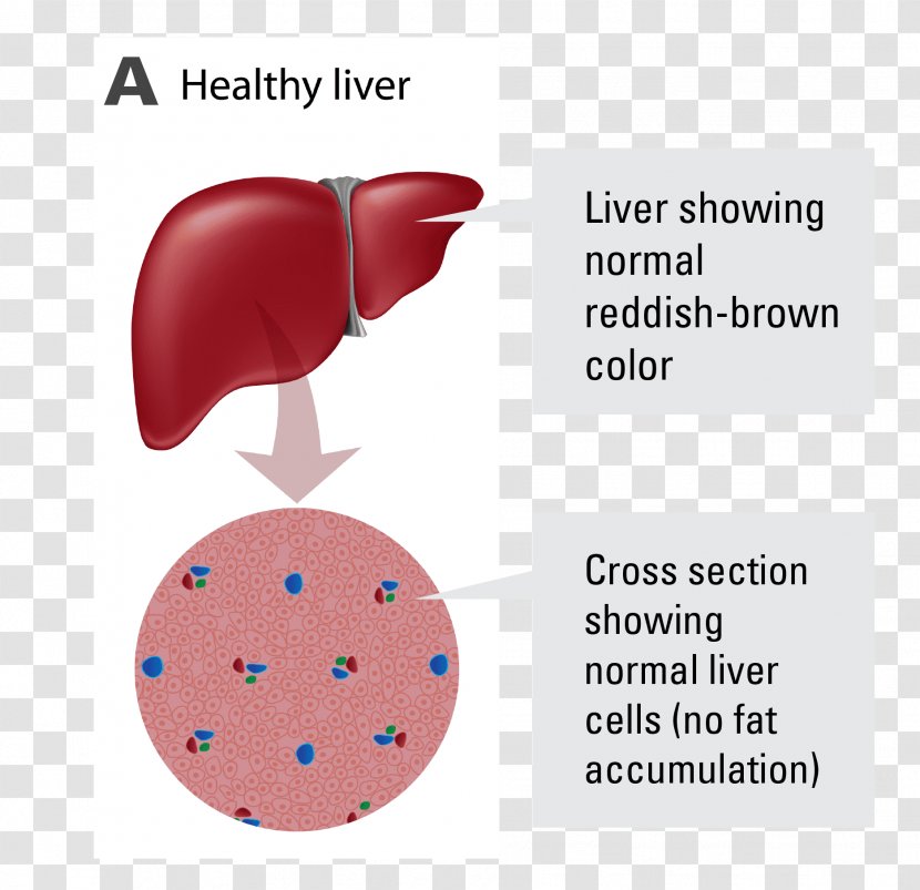 Non-alcoholic Fatty Liver Disease Alcoholic - Frame Transparent PNG