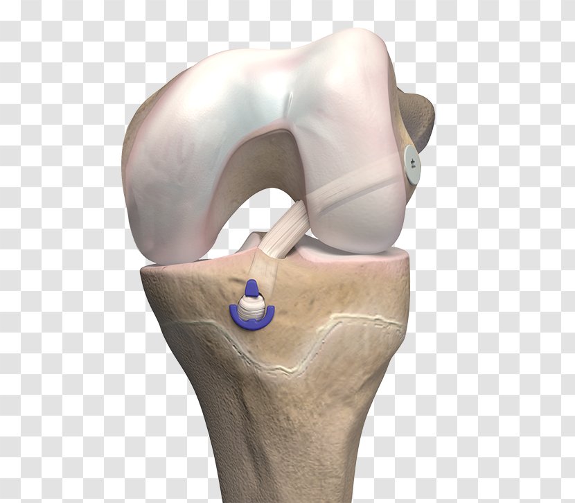 Anterior Cruciate Ligament Reconstruction Bone - Tissue Transparent PNG