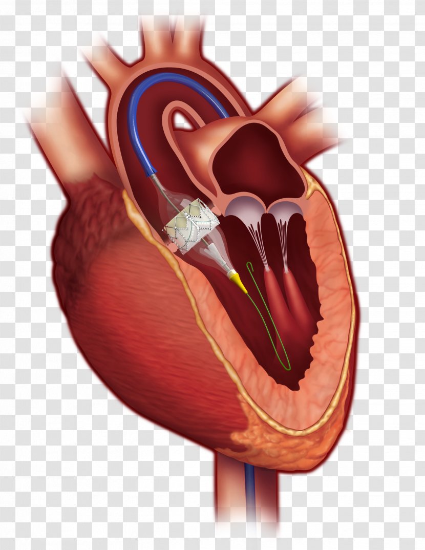 Percutaneous Aortic Valve Replacement Stenosis Heart - Flower Transparent PNG