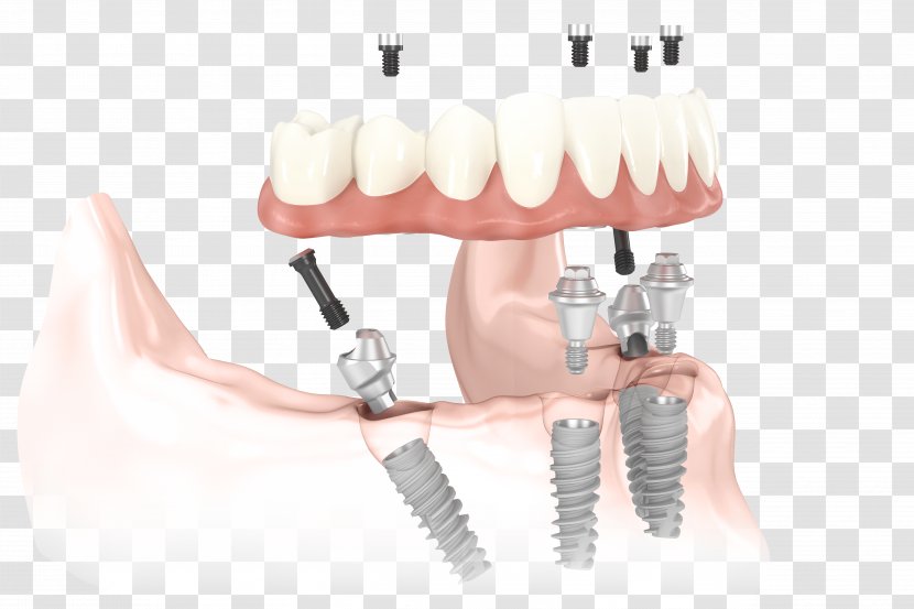 Dental Implant All-on-4 Dentistry Dentures - Dentist Transparent PNG
