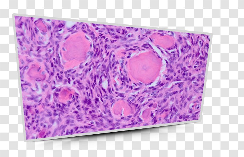 Peripheral Ossifying Fibroma Osteofibrous Dysplasia Pathology Nonossifying - Fibrous Of Bone - Histology Transparent PNG