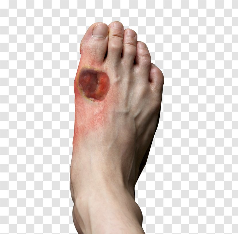 Diabetic Foot Ulcer Diabetes Mellitus Athlete's - Silhouette - Wounds Transparent PNG