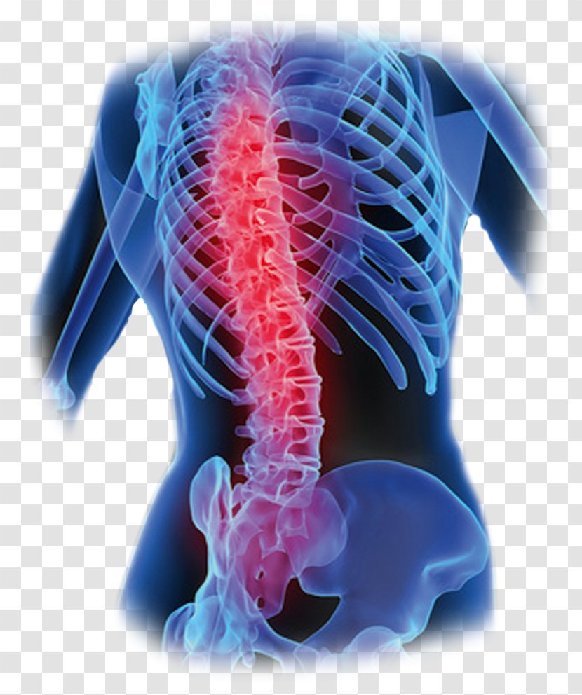 Low Back Pain Vertebral Column Bone Human - Surgery Transparent PNG