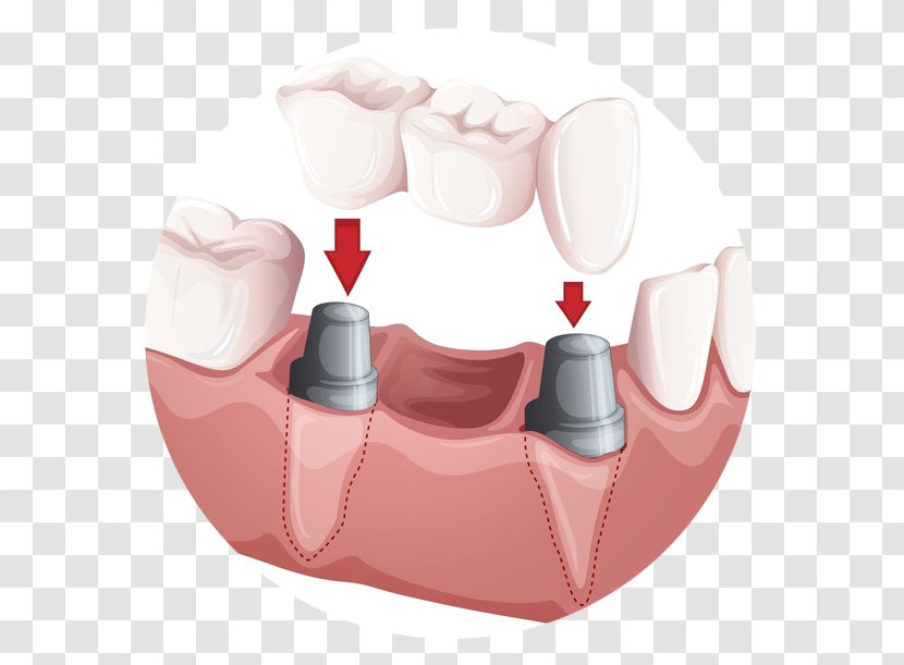 Bridge Dentistry Crown Dental Implant - Implants Transparent PNG