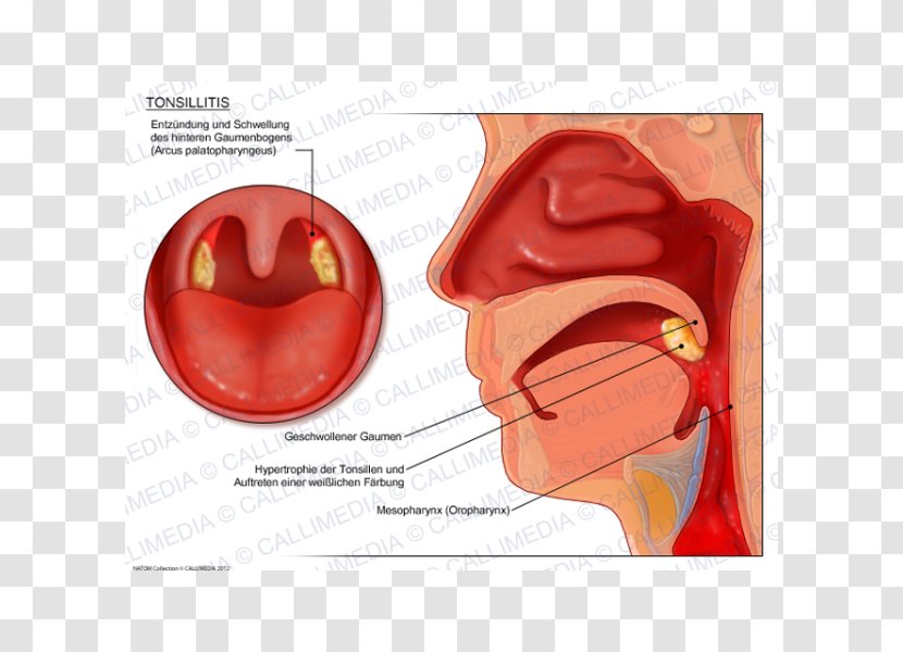 Tonsillitis Otorhinolaryngology Pharyngitis Oropharyngeal Cancer - Love - Nose Transparent PNG