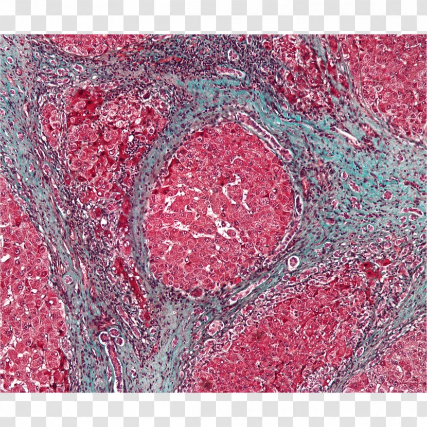 Cirrhosis Non-alcoholic Fatty Liver Disease Alcoholic - Tree - Forensic Transparent PNG