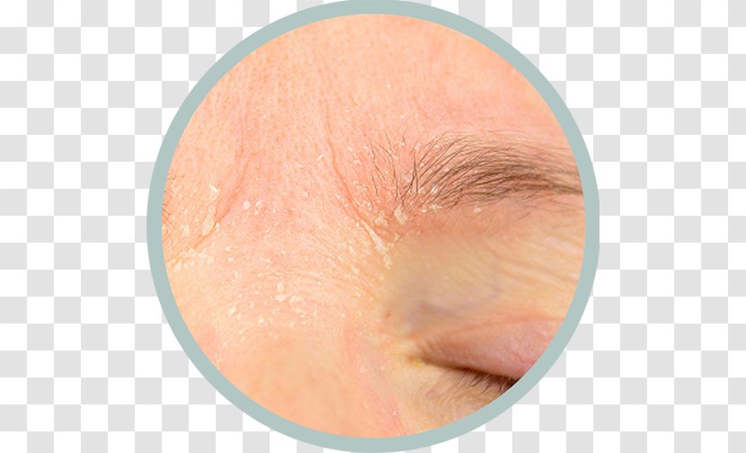 Seborrheic Dermatitis Cutaneous Condition Itch Skin - Cartoon - Eyelids Transparent PNG