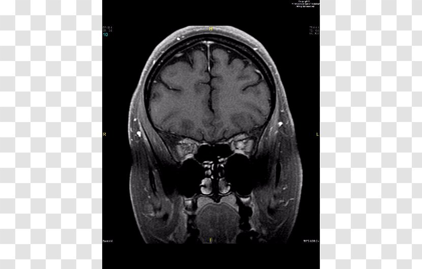 Skull Medical Radiography Computed Tomography Medicine Brain - Frame Transparent PNG