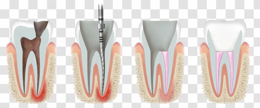 Endodontic Therapy Endodontics Dentistry - Pulp - Medicine Transparent PNG