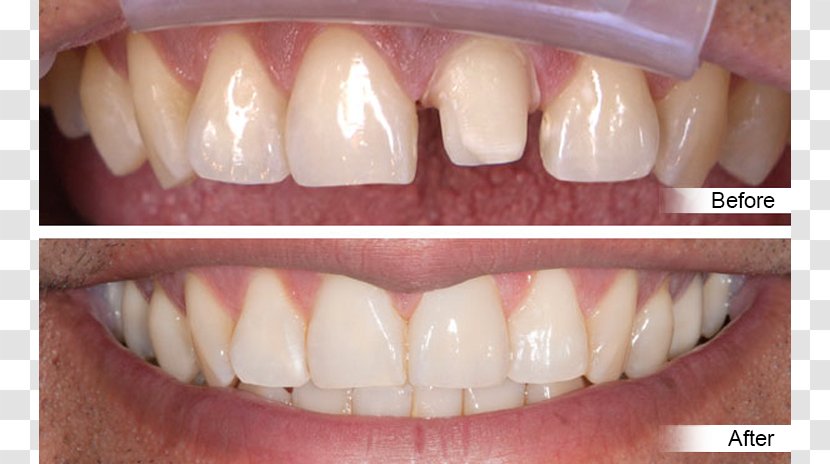 Crown Tooth Dentistry Dental Restoration - Diagnosisrelated Group Transparent PNG