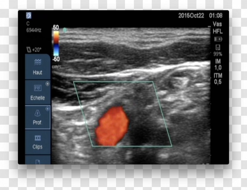 Medical Imaging Carotid Ultrasonography Doppler Echocardiography Ultrasound - Joint - Blood Flow Transparent PNG